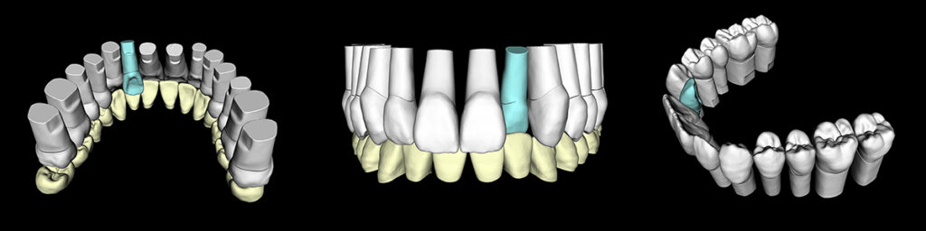 1歯反対咬合の生活側切歯3Dイラスト