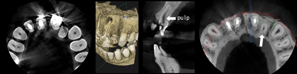 1歯反対咬合の側切歯CTによる診断画像
