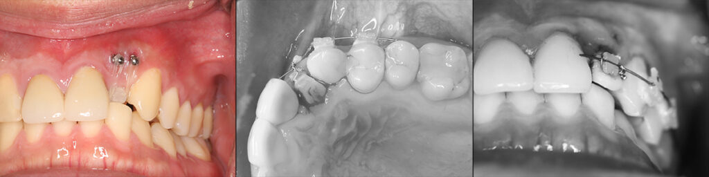 1歯反対咬合の側切歯の圧下矯正と前方傾斜移動
