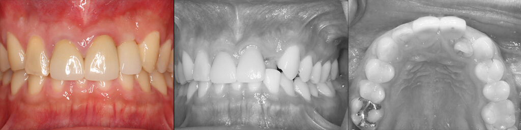 1歯反対咬合の側切歯治療後と術前写真
