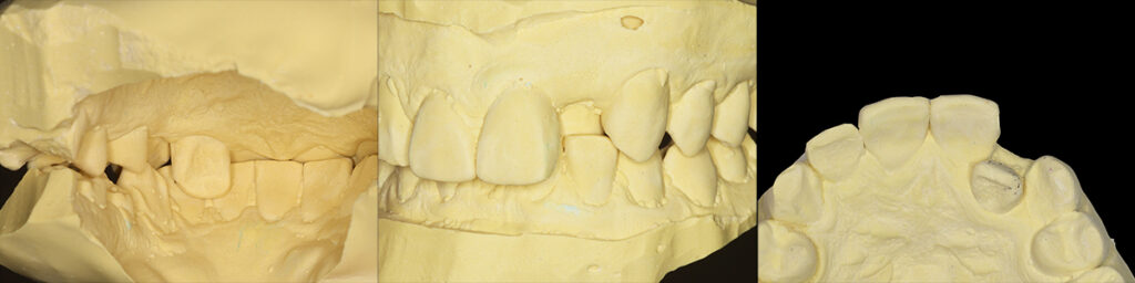 1歯反対咬合の側切歯術前模型

