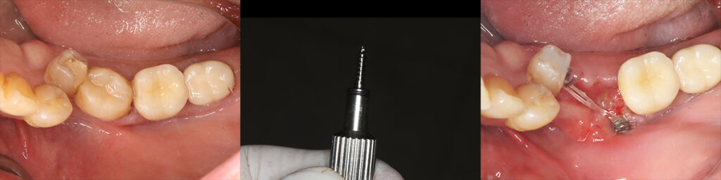 下側転移した下顎小臼歯と保存不能大臼歯抜歯同時に適切な位置にアンカースクリュー固定