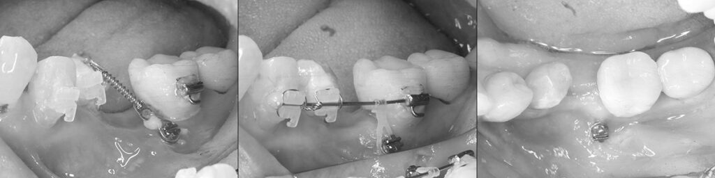 矯正力で約４か月で頬側後方に移動させる