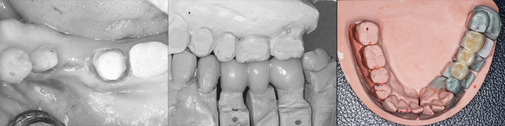 矯正後に支台歯の形成と補綴物の製作