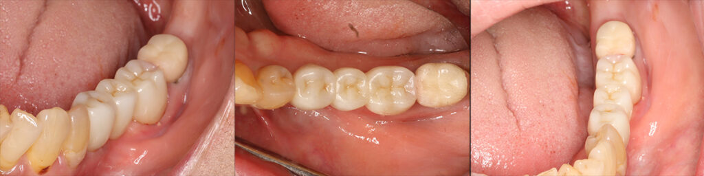 矯正後に製作したブリッジが装着された口腔内