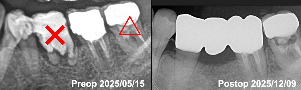 術前の第一大臼歯は保存不能も第二小臼歯が舌側転移のため、このままでは利用できないため大臼歯抜歯時にアンカースクリュー設置して小臼歯の矯正してブリッジ修復のX線画像