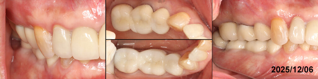 上下臼歯部すれ違い咬合の矯正再建の術後2025/12/07